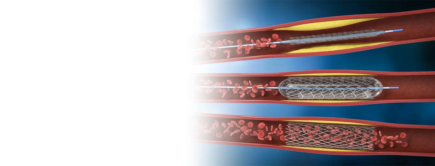 Best Heart Specialist in Patna for Angiography & Angioplasty: When Expert Cardiac Care Matters Most